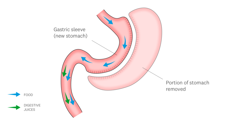 Gastric Sleeve Discover Weight Loss