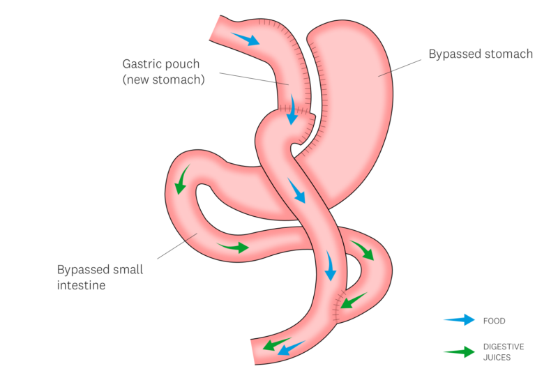 Roux en Y gastric bypass weight loss surgery options